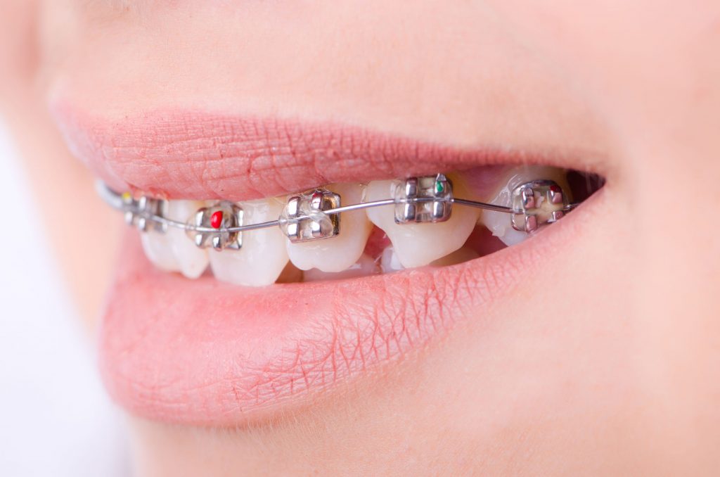mouth with brackets braces in medical concept